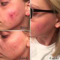 3-Step Acne System - BIG FRENCHIES