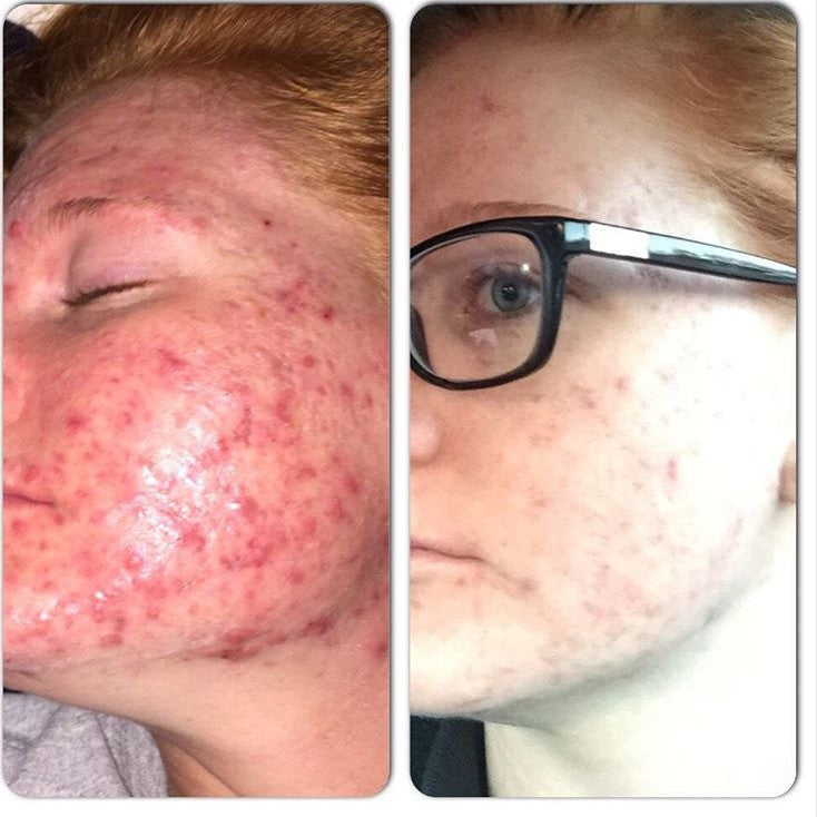 3-Step Acne System - BIG FRENCHIES