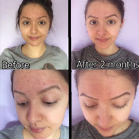 3-Step Acne System - BIG FRENCHIES