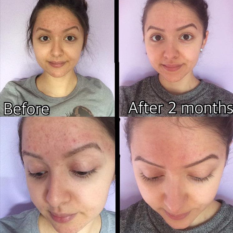 3-Step Acne System - BIG FRENCHIES