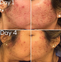 3-Step Acne System - BIG FRENCHIES