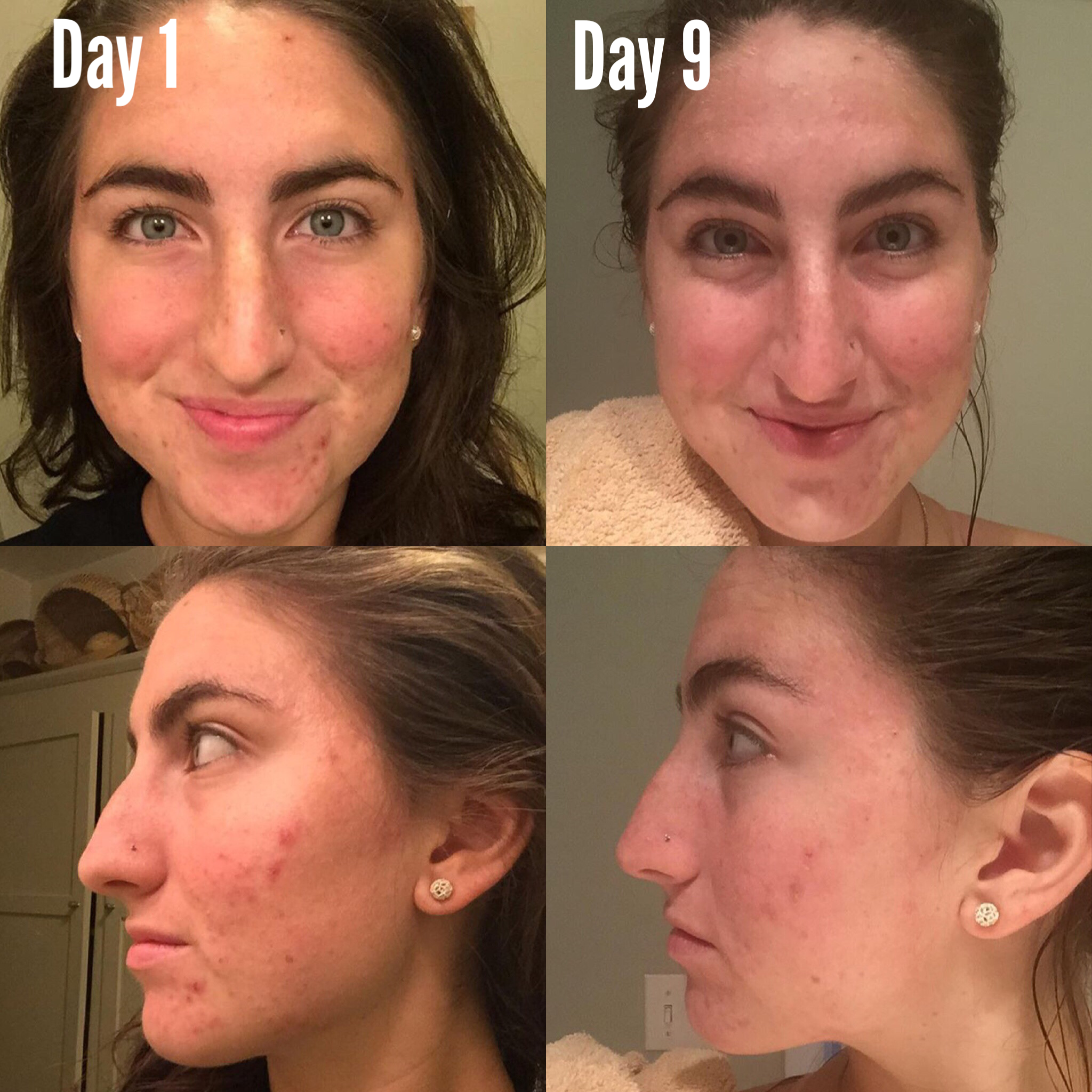 3-Step Acne System - BIG FRENCHIES