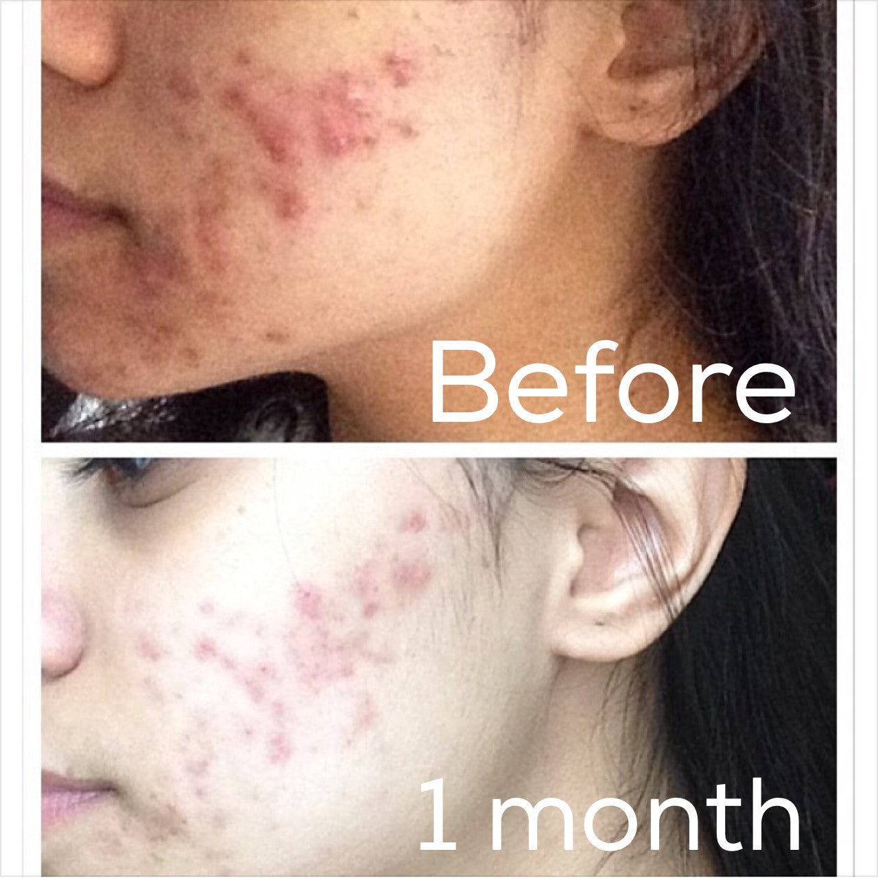 3-Step Acne System - BIG FRENCHIES