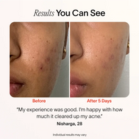 Bye Acne: 3-Minute Pimple Spot Treatment